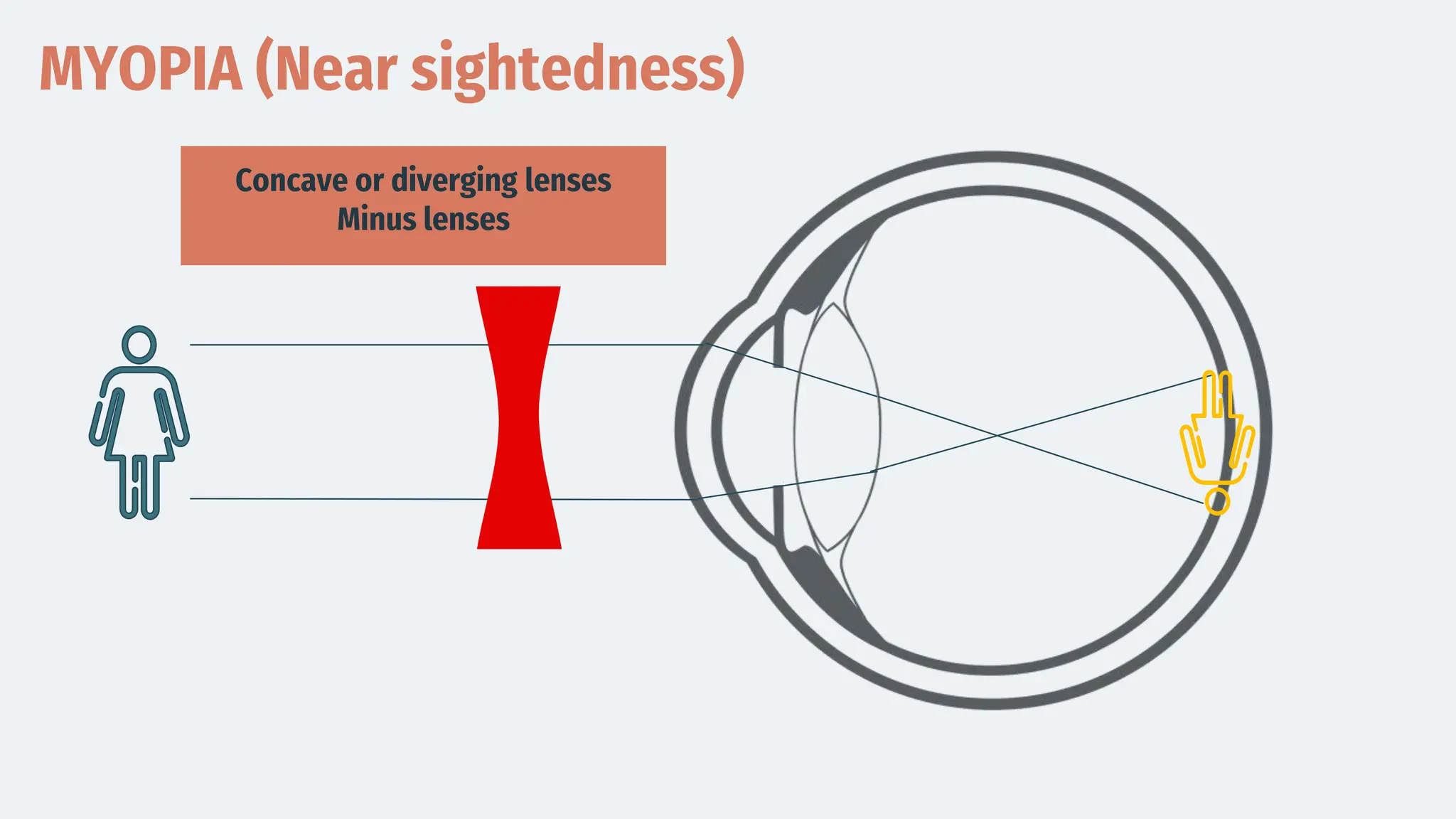 MYOPIA (Near sightedness)
Concave or diverging lenses
Minus lenses
 