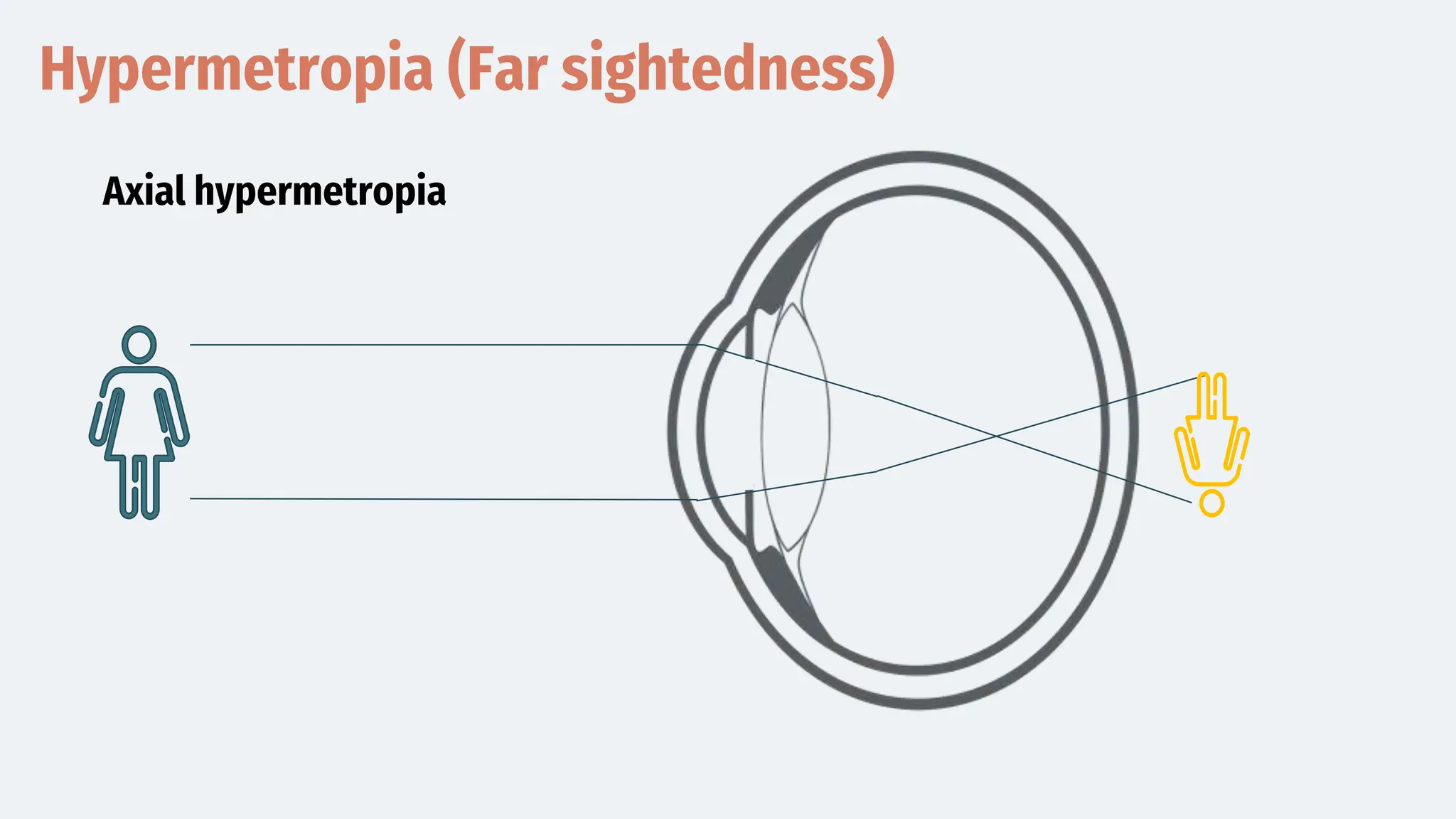 Hypermetropia (Far sightedness)
Axial hypermetropia
 