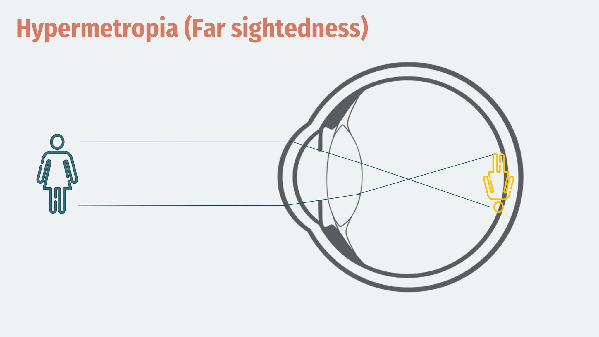 Hypermetropia (Far sightedness)
 