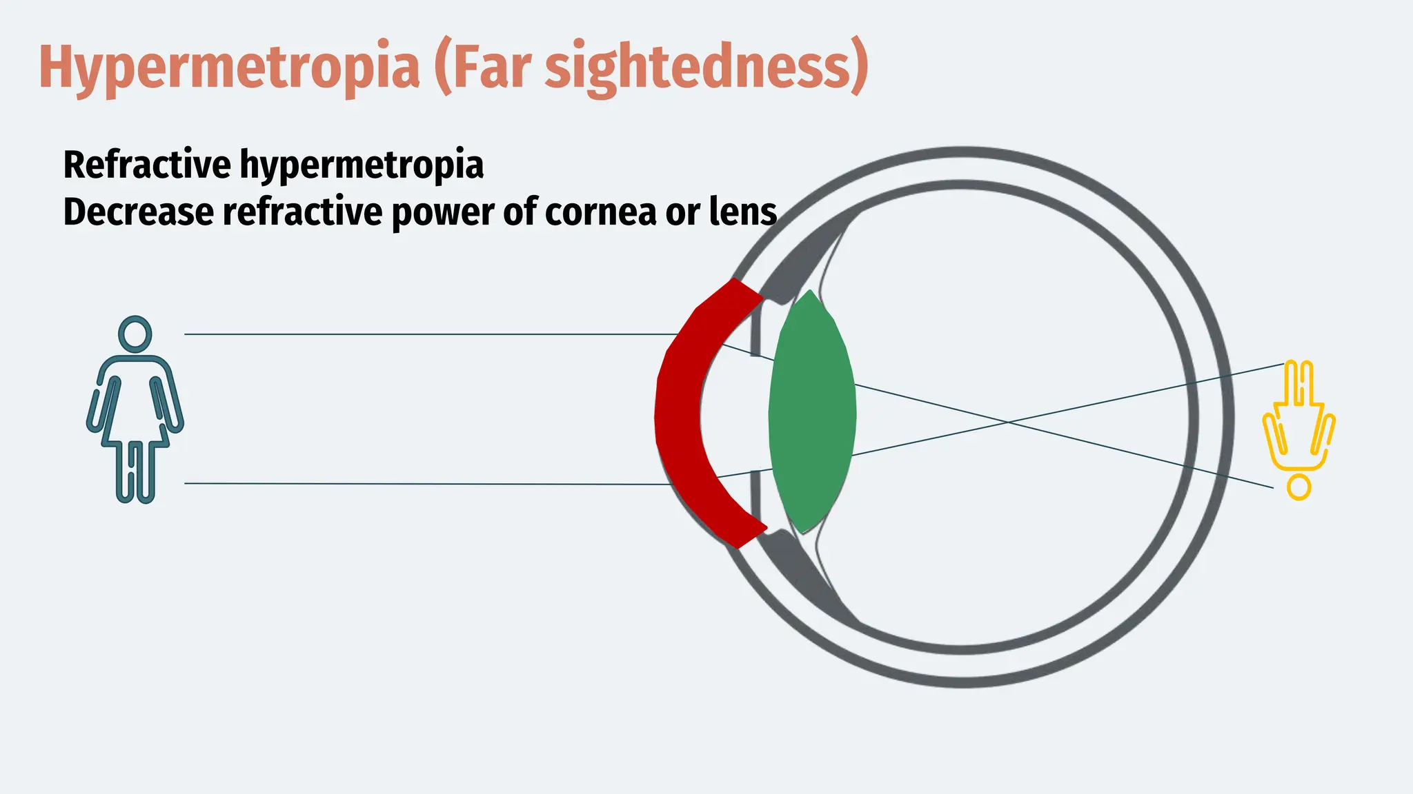 Hypermetropia (Far sightedness)
Refractive hypermetropia
Decrease refractive power of cornea or lens
 