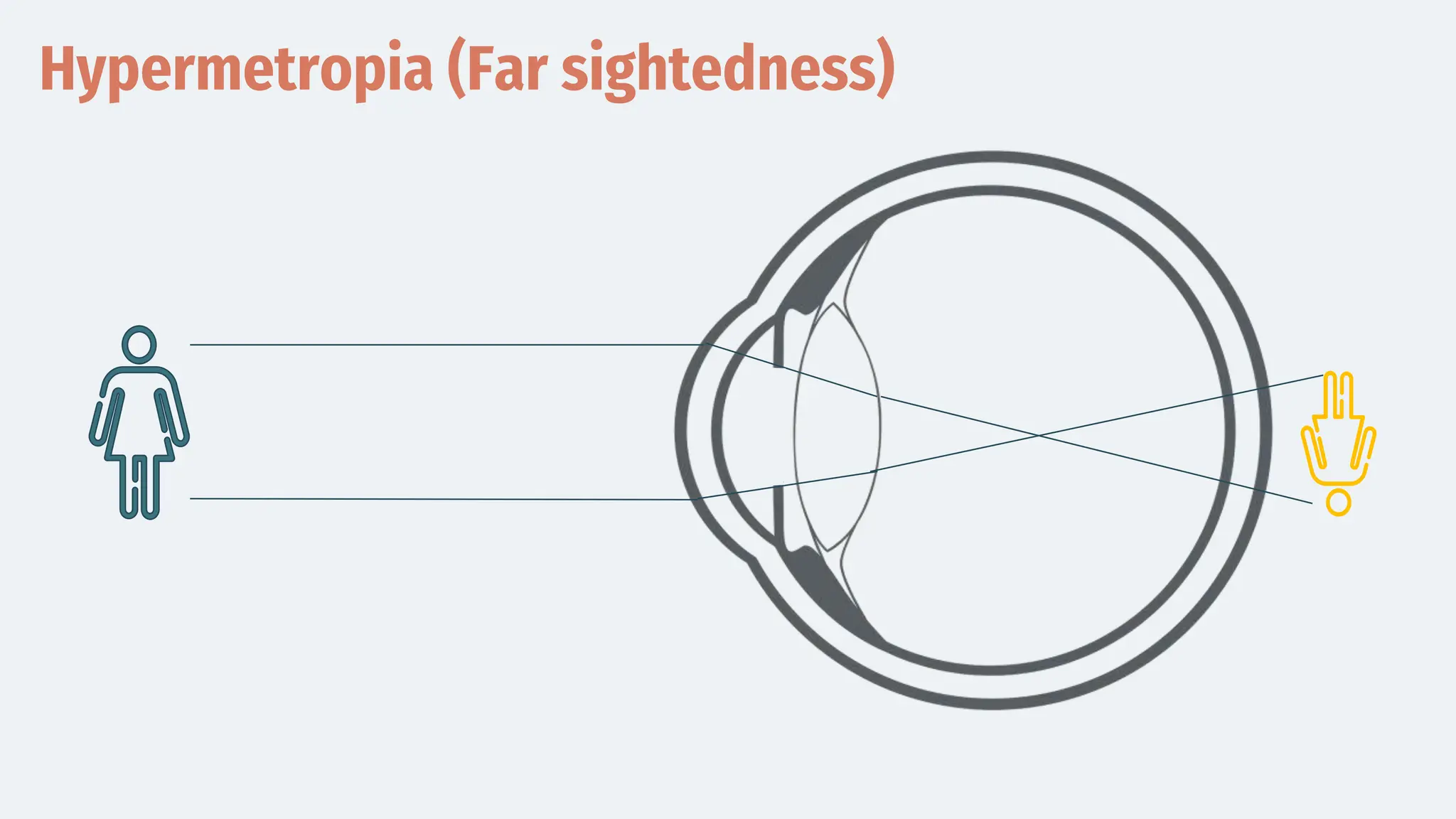 Hypermetropia (Far sightedness)
 
