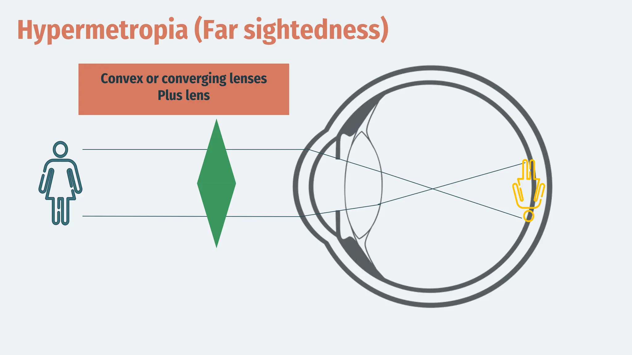 Hypermetropia (Far sightedness)
Convex or converging lenses
Plus lens
 