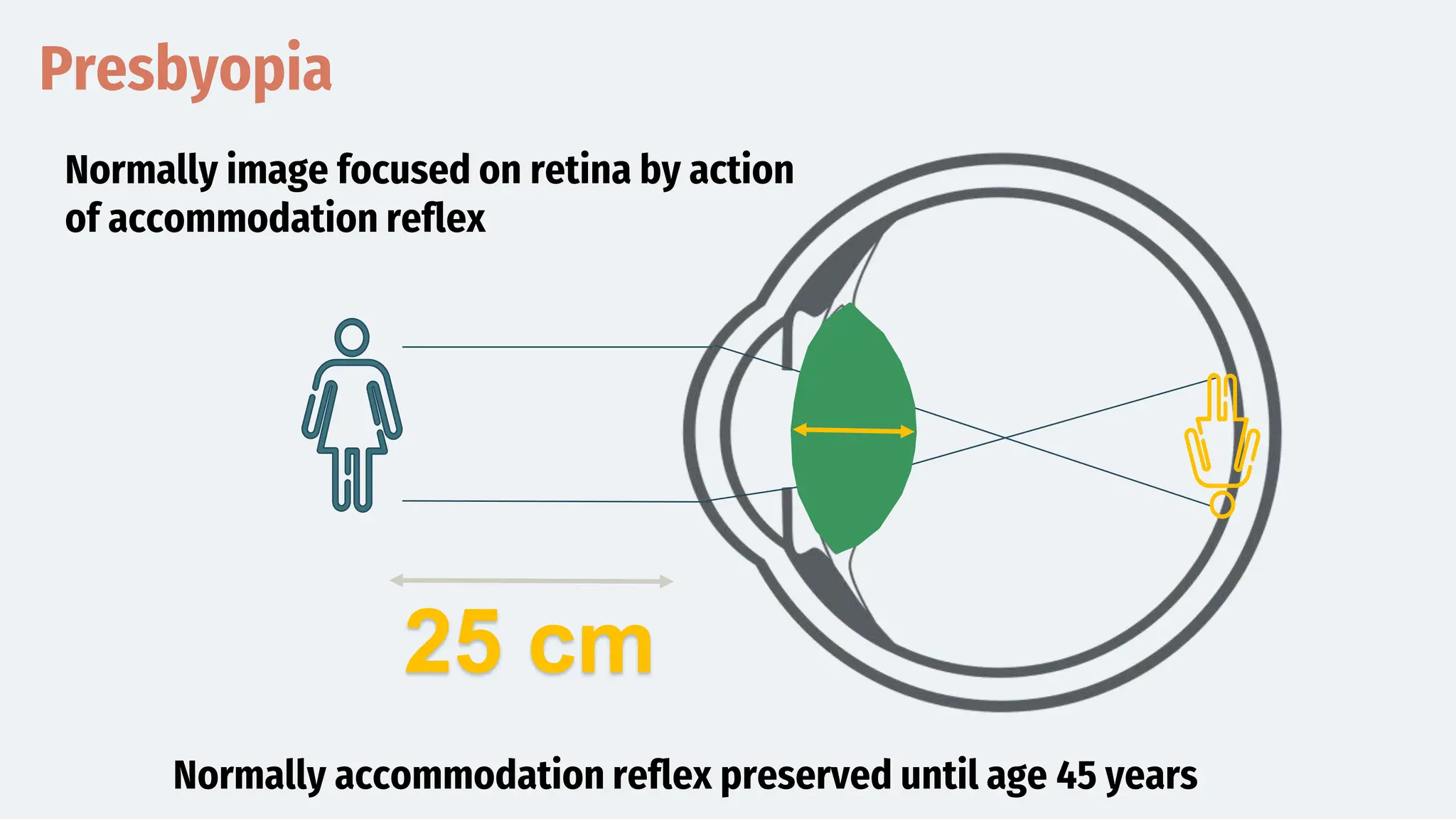 Presbyopia
25 cm
Normally image focused on retina by action
of accommodation reflex
Normally accommodation reflex preserved until age 45 years
 