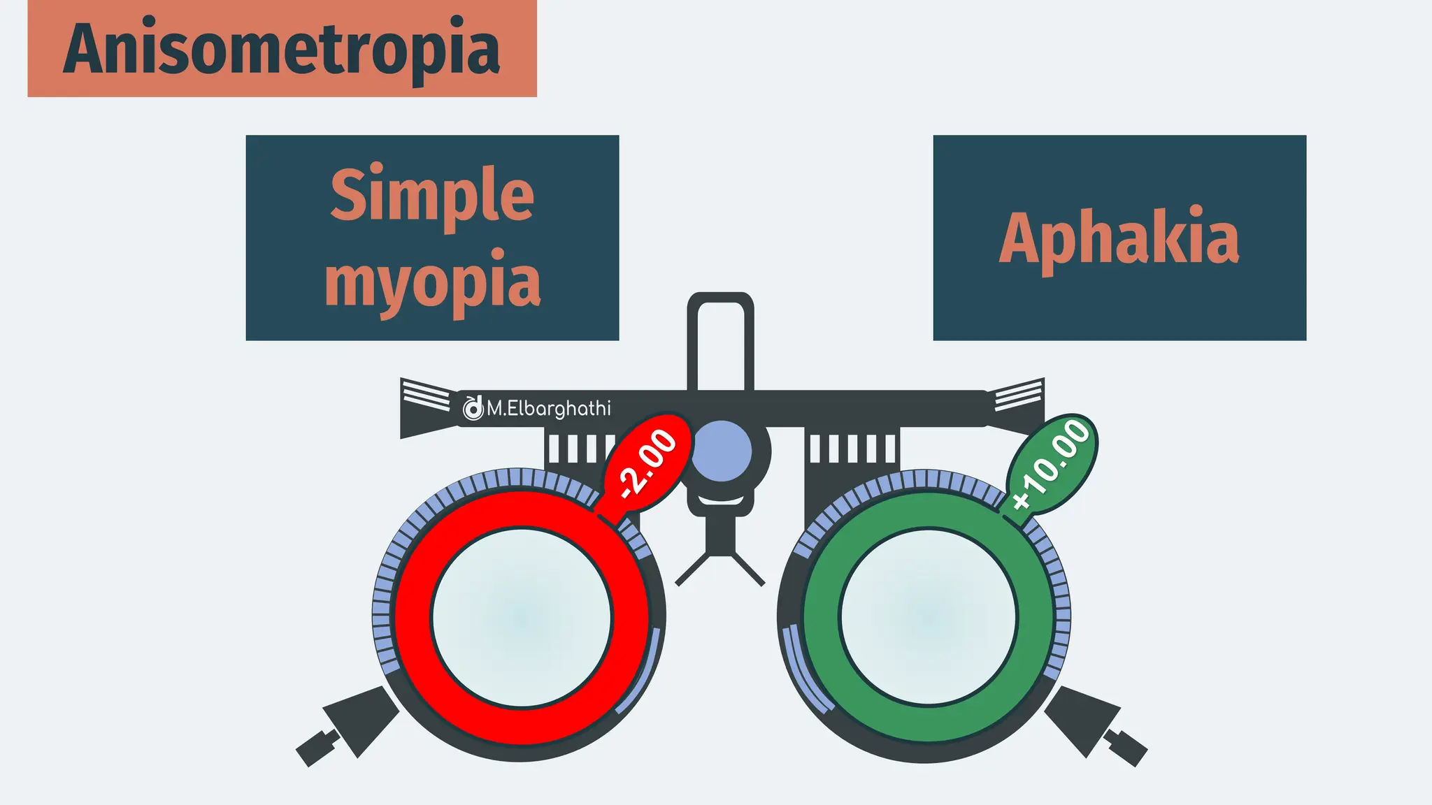 Anisometropia
Aphakia
Simple
myopia
 