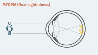 MYOPIA (Near sightedness)
 
