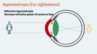 Hypermetropia (Far sightedness)
Refractive hypermetropia
Decrease refractive power of cornea or lens
 