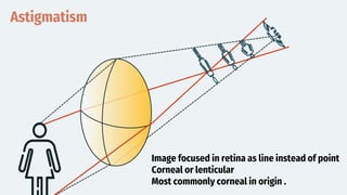 Astigmatism
Image focused in retina as line instead of point
Corneal or lenticular
Most commonly corneal in origin .
 