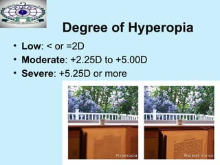 15
Degree of Hyperopia
• Low: < or =2D
• Moderate: +2.25D to +5.00D
• Severe: +5.25D or more
 