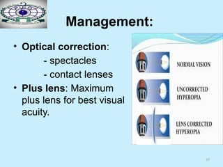 19
Management:
• Optical correction:
- spectacles
- contact lenses
• Plus lens: Maximum
plus lens for best visual
acuity.
 