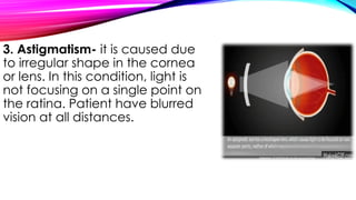 3. Astigmatism- it is caused due
to irregular shape in the cornea
or lens. In this condition, light is
not focusing on a single point on
the ratina. Patient have blurred
vision at all distances.
 