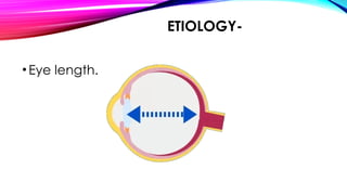 ETIOLOGY-
•Eye length.
 