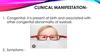 CLINICAL MANIFESTATION-
1. Congenital- it is present at birth and associated with
other congenital abnormality of eyeball.
2. Symptoms -
 
