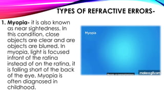 TYPES OF REFRACTIVE ERRORS-
1. Myopia- it is also known
as near sightedness. In
this condition, close
objects are clear and are
objects are blurred. In
myopia, light is focused
infront of the ratina
instead of on the ratina, it
is falling short of the back
of the eye. Myopia is
often diagnosed in
childhood.
 