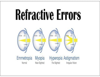 Reflective Error Refractive Error.ppt, understanding the basics | PPTX