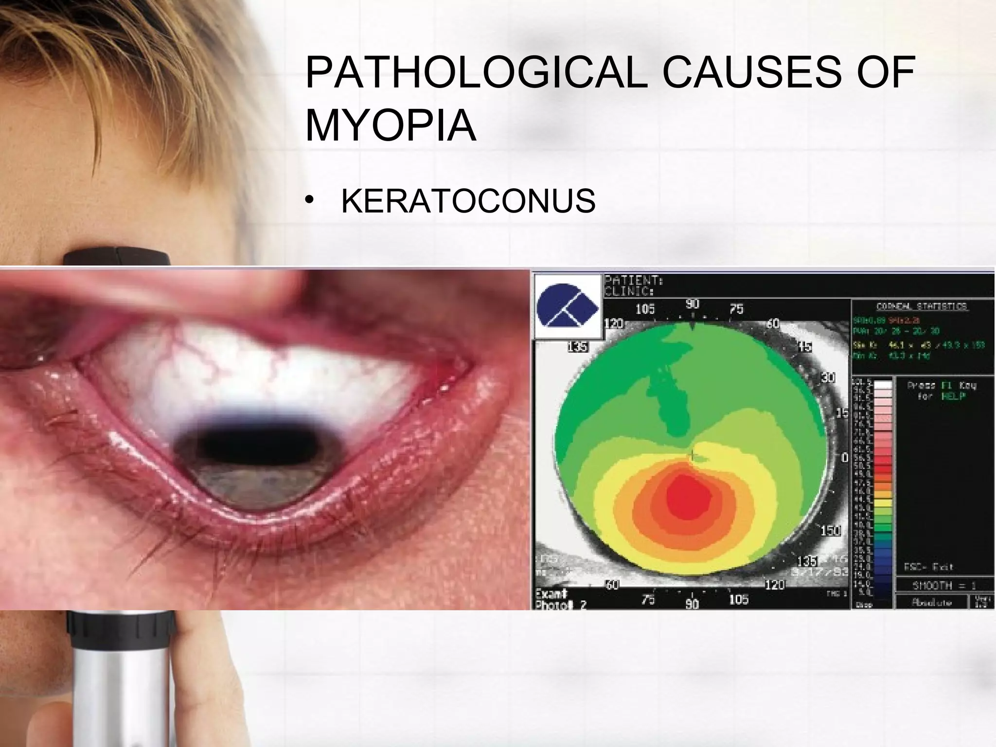 PATHOLOGICAL CAUSES OF
MYOPIA
• KERATOCONUS
 
