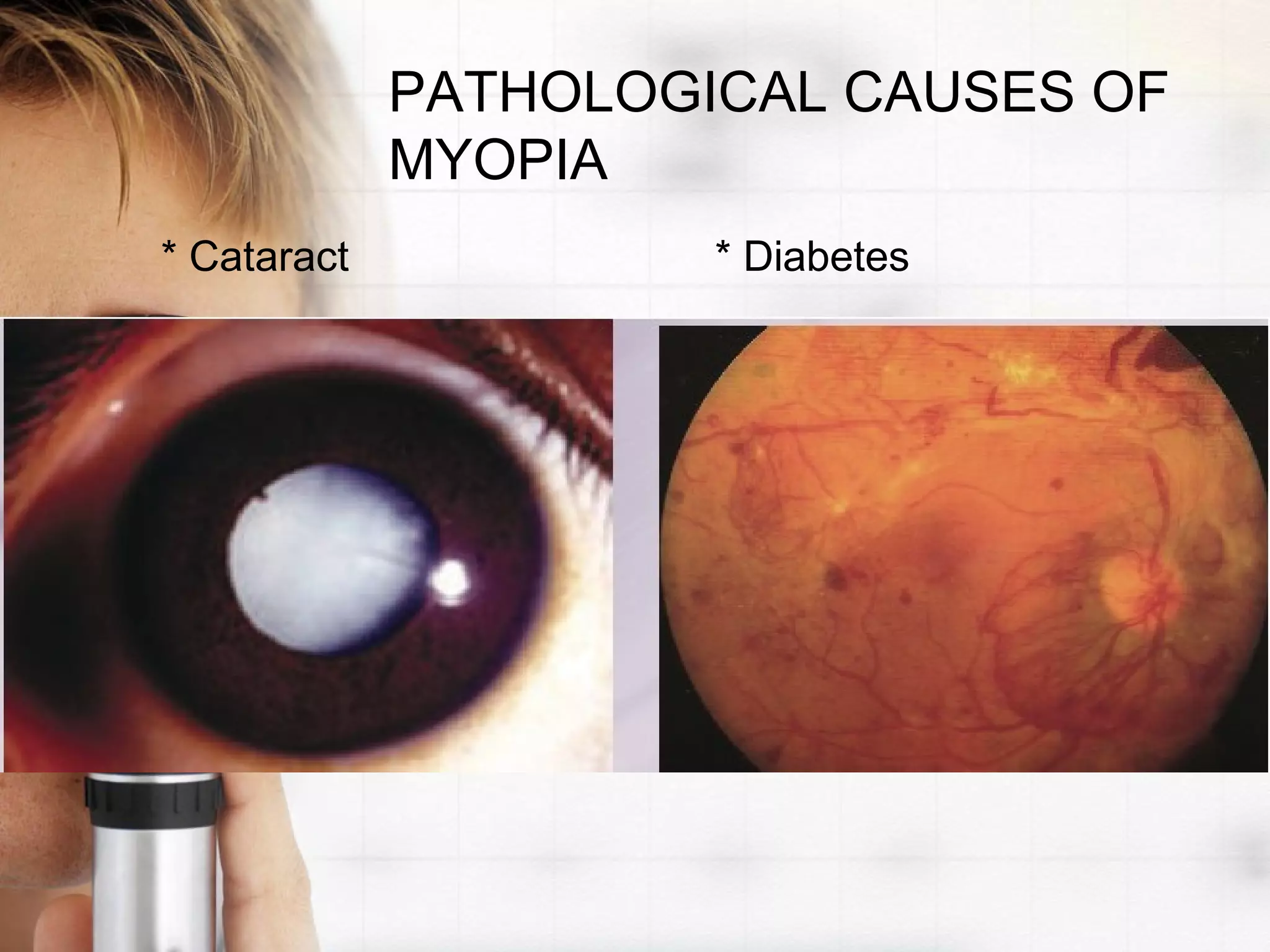PATHOLOGICAL CAUSES OF
MYOPIA
* Cataract * Diabetes
 