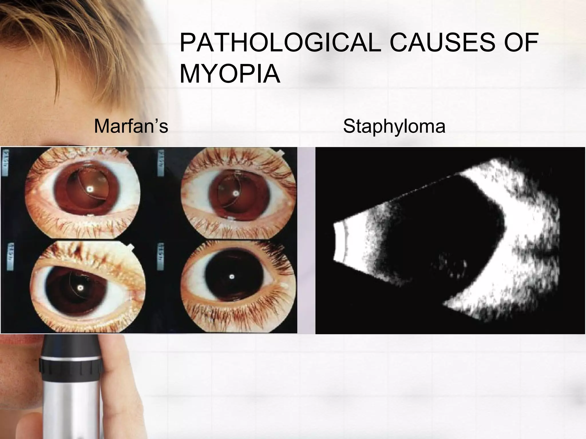 PATHOLOGICAL CAUSES OF
MYOPIA
Marfan’s Staphyloma
 