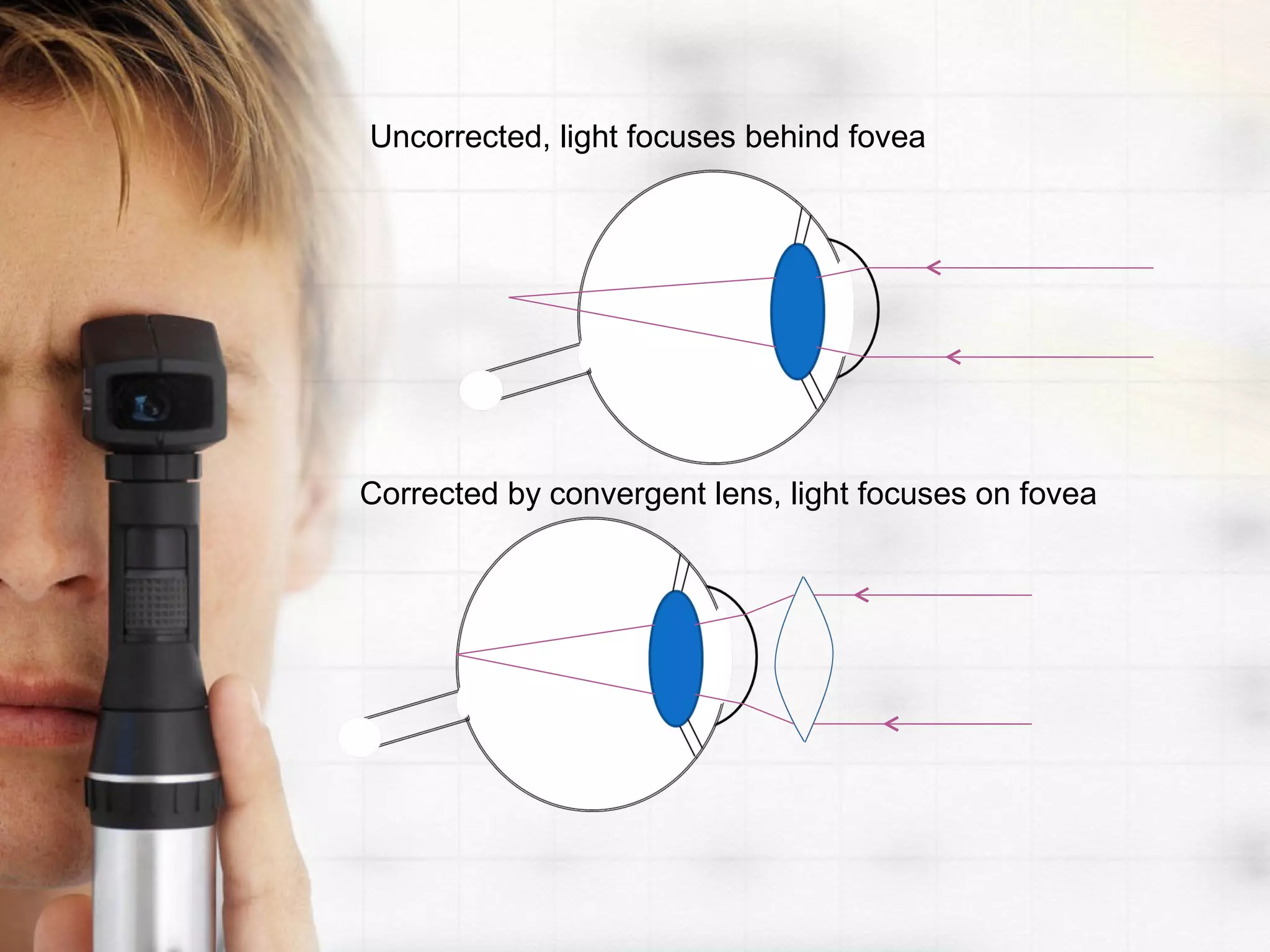 Uncorrected, light focuses behind fovea
Corrected by convergent lens, light focuses on fovea
 