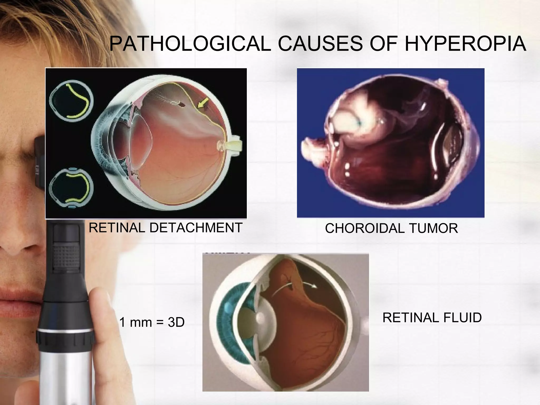 PATHOLOGICAL CAUSES OF HYPEROPIA
RETINAL DETACHMENT
1 mm = 3D RETINAL FLUID
CHOROIDAL TUMOR
 