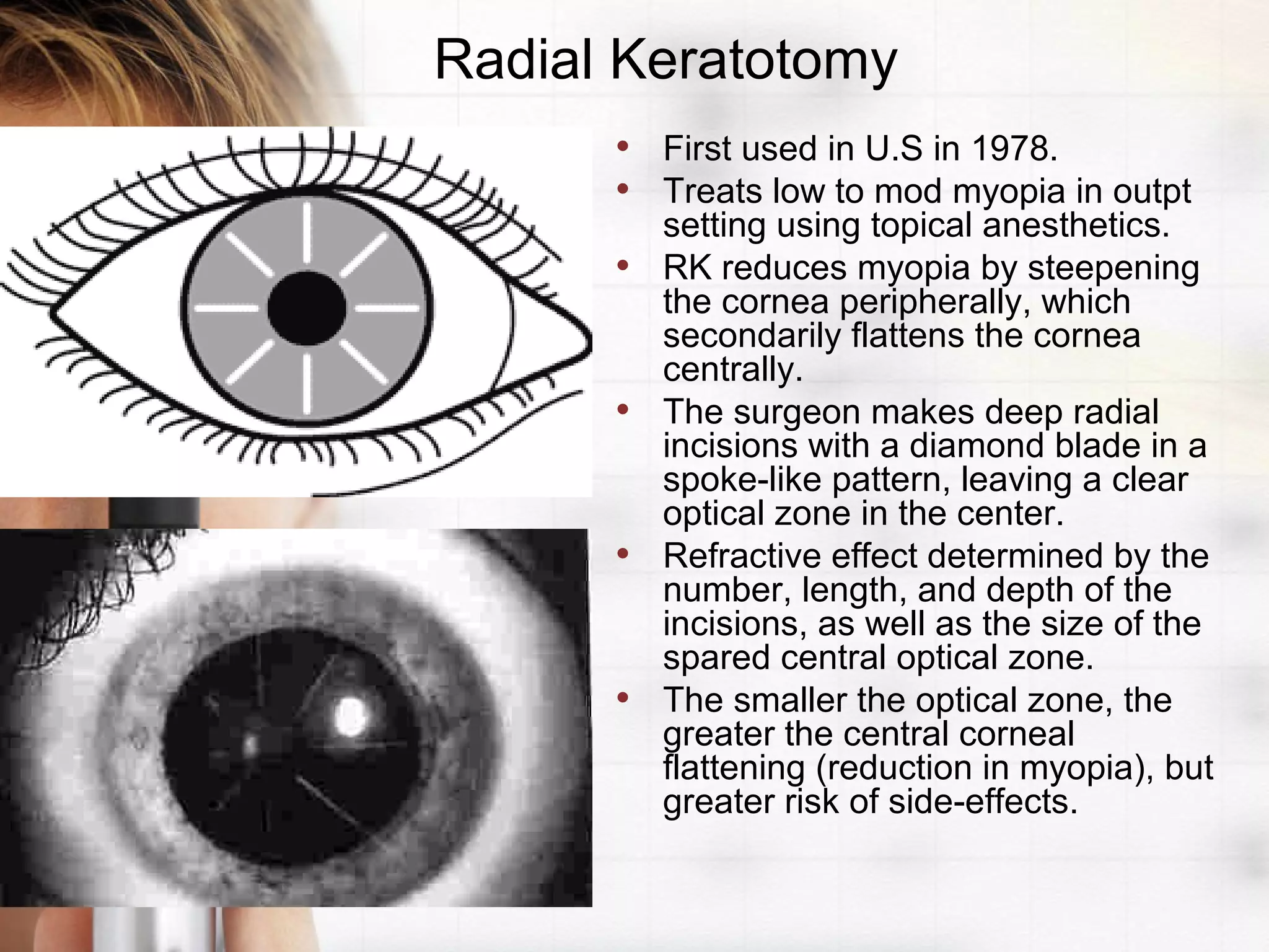 • First used in U.S in 1978.
• Treats low to mod myopia in outpt
setting using topical anesthetics.
• RK reduces myopia by steepening
the cornea peripherally, which
secondarily flattens the cornea
centrally.
• The surgeon makes deep radial
incisions with a diamond blade in a
spoke-like pattern, leaving a clear
optical zone in the center.
• Refractive effect determined by the
number, length, and depth of the
incisions, as well as the size of the
spared central optical zone.
• The smaller the optical zone, the
greater the central corneal
flattening (reduction in myopia), but
greater risk of side-effects.
Radial Keratotomy
 