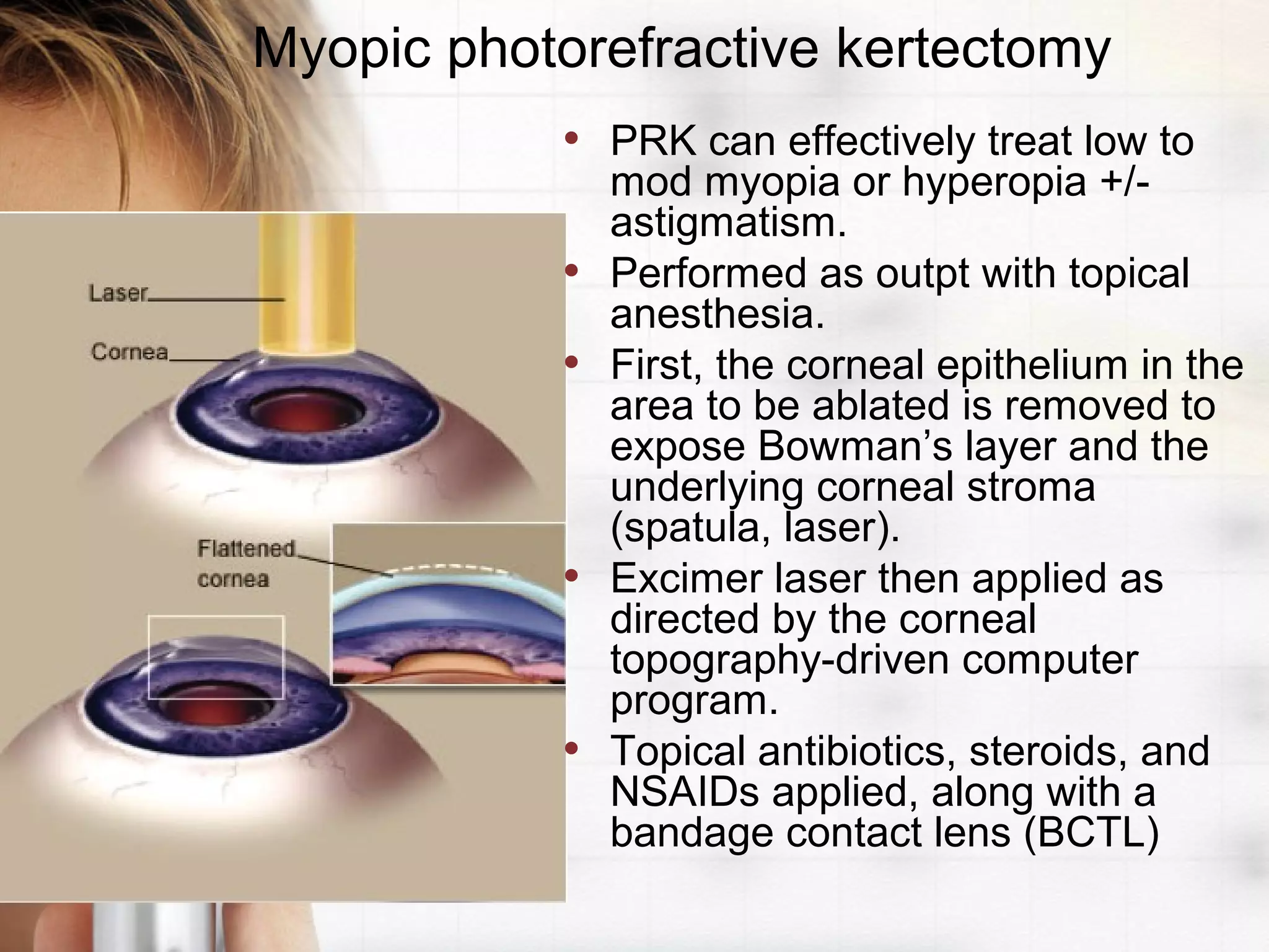 Myopic photorefractive kertectomy
• PRK can effectively treat low to
mod myopia or hyperopia +/-
astigmatism.
• Performed as outpt with topical
anesthesia.
• First, the corneal epithelium in the
area to be ablated is removed to
expose Bowman’s layer and the
underlying corneal stroma
(spatula, laser).
• Excimer laser then applied as
directed by the corneal
topography-driven computer
program.
• Topical antibiotics, steroids, and
NSAIDs applied, along with a
bandage contact lens (BCTL)
 