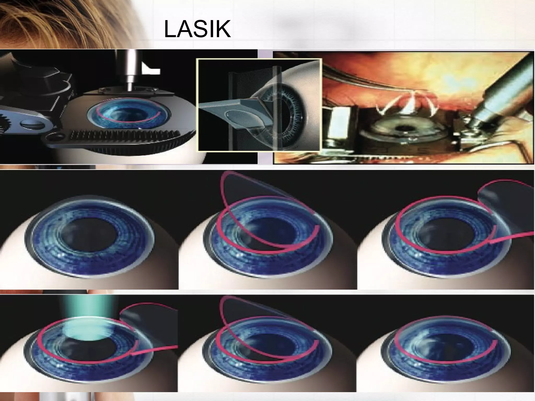 LASIK
 