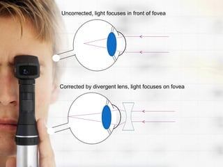Uncorrected, light focuses in front of fovea




Corrected by divergent lens, light focuses on fovea
 