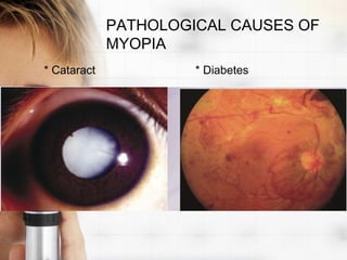 PATHOLOGICAL CAUSES OF
             MYOPIA
* Cataract            * Diabetes
 