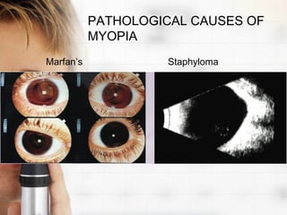 PATHOLOGICAL CAUSES OF
           MYOPIA
Marfan’s            Staphyloma
 