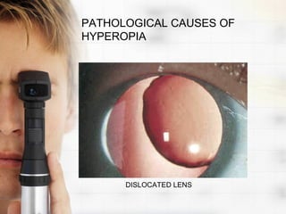 PATHOLOGICAL CAUSES OF
HYPEROPIA




      DISLOCATED LENS
 