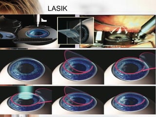 LASIK
 
