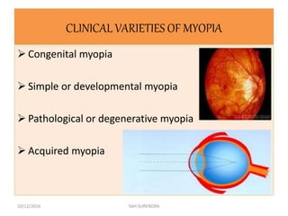 CLINICAL VARIETIES OF MYOPIA
 Congenital myopia
 Simple or developmental myopia
 Pathological or degenerative myopia
 Acquired myopia
10/12/2016 SAH SURENDRA
 