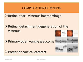 COMPLICATION OF MYOPIA
Retinal tear –vitreous haemorrhage
Retinal detachment degeneration of the
vitreous
Primary open –angle glaucoma
Posterior cortical cataract
10/12/2016 SAH SURENDRA
 