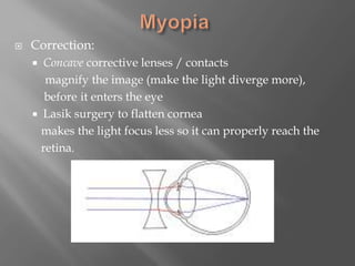  Correction:
 Concave corrective lenses / contacts
magnify the image (make the light diverge more),
before it enters the eye
 Lasik surgery to flatten cornea
makes the light focus less so it can properly reach the
retina.
 