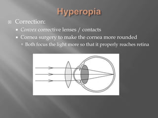  Correction:
 Convex corrective lenses / contacts
 Cornea surgery to make the cornea more rounded
 Both focus the light more so that it properly reaches retina
 