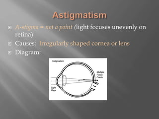  A-stigma = not a point (light focuses unevenly on
retina)
 Causes: Irregularly shaped cornea or lens
 Diagram:
 