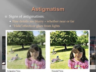  Signs of astigmatism:
 Fine details are blurry – whether near or far
 “Halo”effects or glare from lights
 