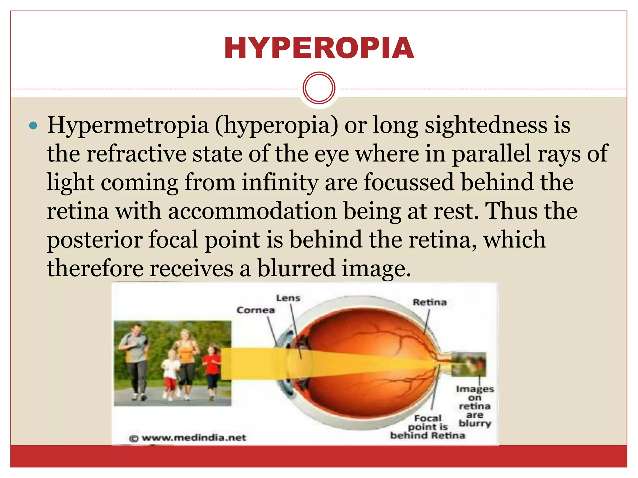 HYPEROPIA
 Hypermetropia (hyperopia) or long sightedness is
the refractive state of the eye where in parallel rays of
light coming from infinity are focussed behind the
retina with accommodation being at rest. Thus the
posterior focal point is behind the retina, which
therefore receives a blurred image.
 