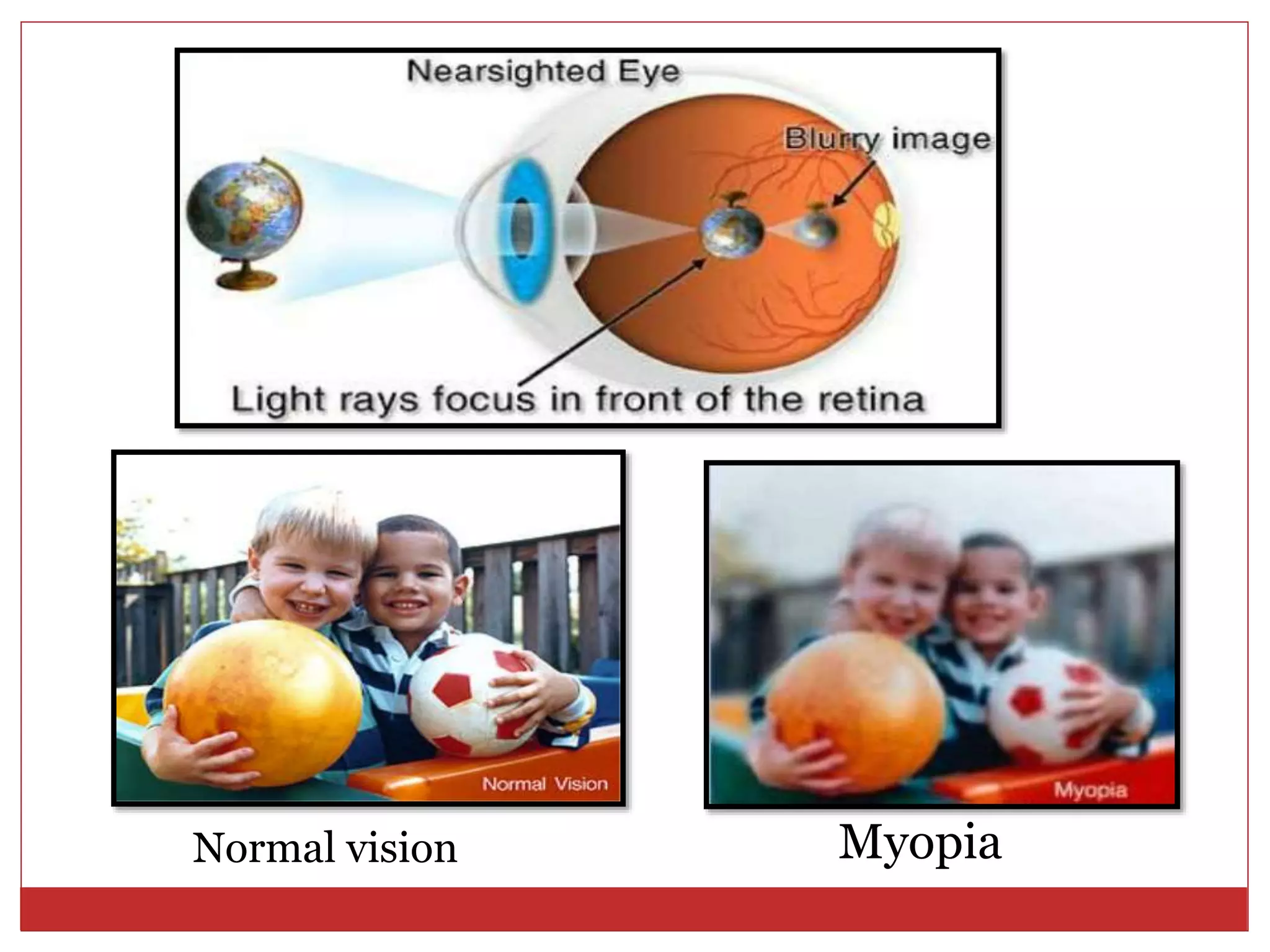 Normal vision Myopia
 
