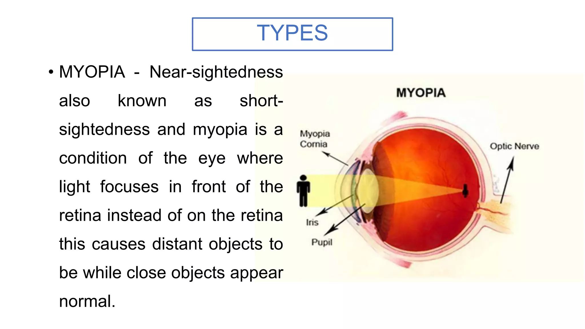 TYPES
• MYOPIA - Near-sightedness
also known as short-
sightedness and myopia is a
condition of the eye where
light focuses in front of the
retina instead of on the retina
this causes distant objects to
be while close objects appear
normal.
 