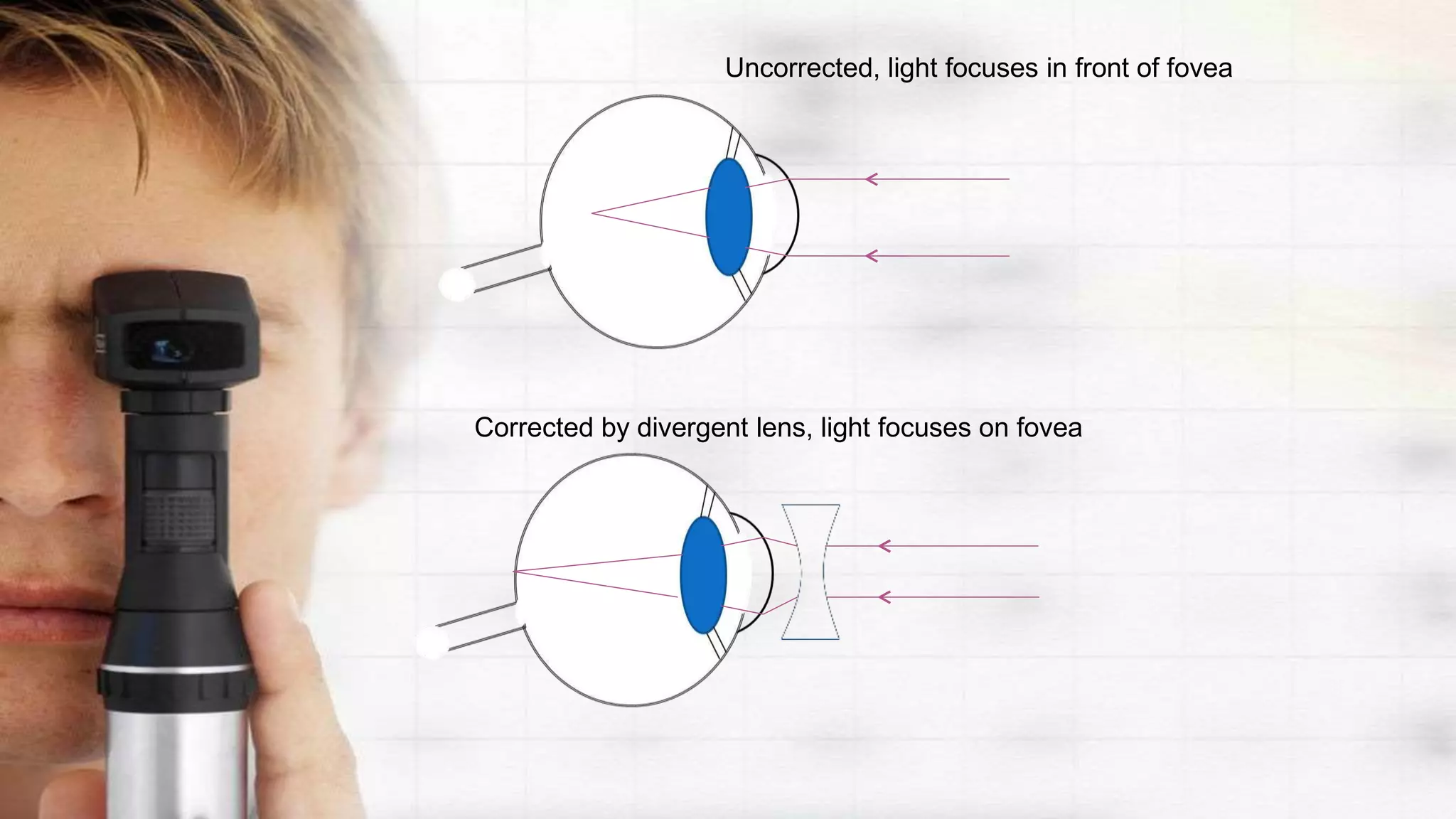 Uncorrected, light focuses in front of fovea
Corrected by divergent lens, light focuses on fovea
 