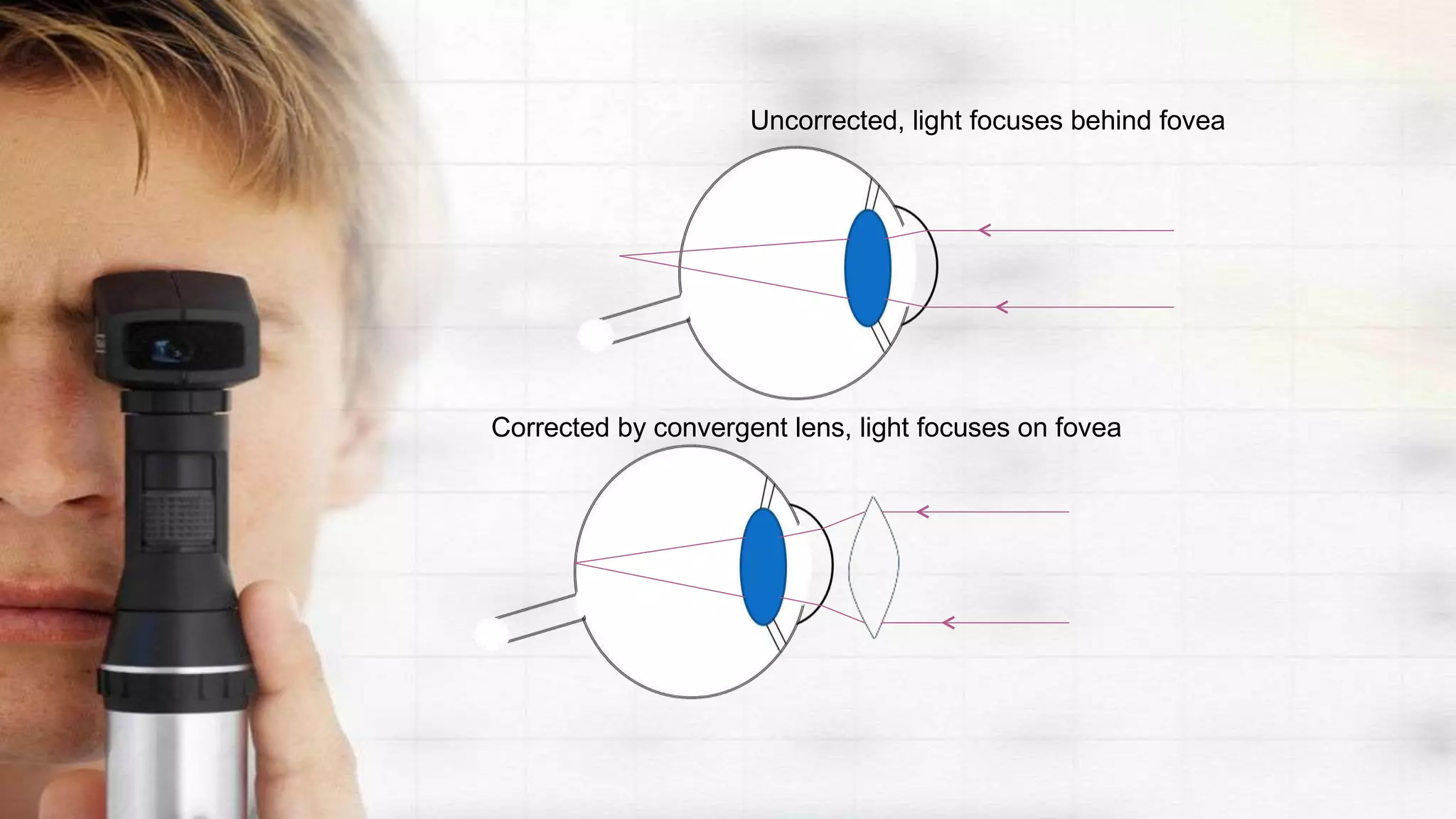 Uncorrected, light focuses behind fovea
Corrected by convergent lens, light focuses on fovea
 