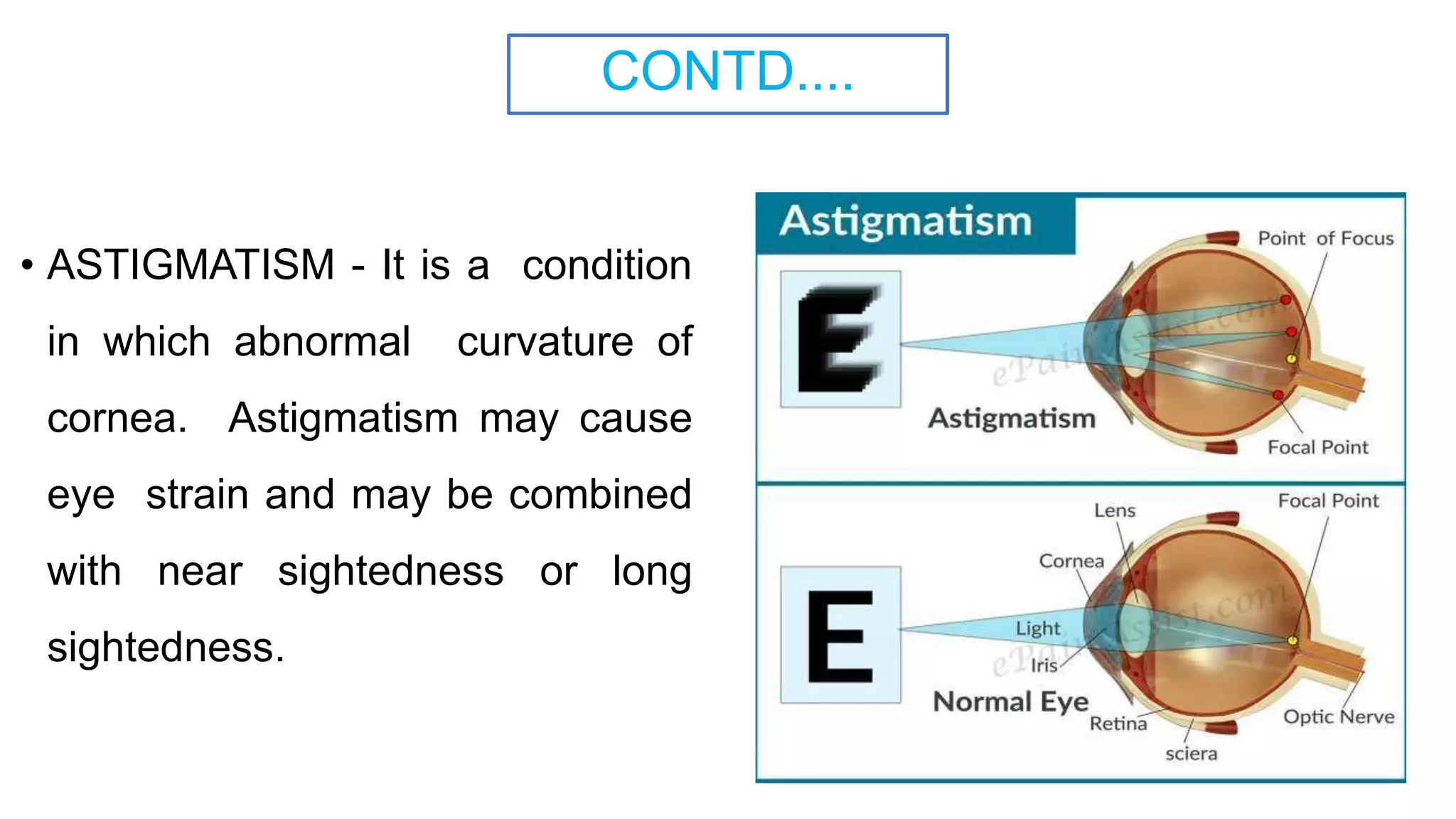CONTD....
• ASTIGMATISM - It is a condition
in which abnormal curvature of
cornea. Astigmatism may cause
eye strain and may be combined
with near sightedness or long
sightedness.
 