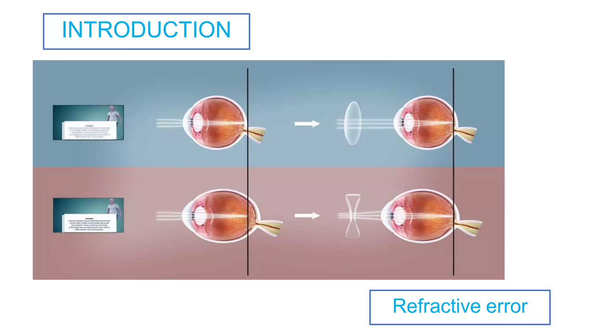 Refractive error
INTRODUCTION
 
