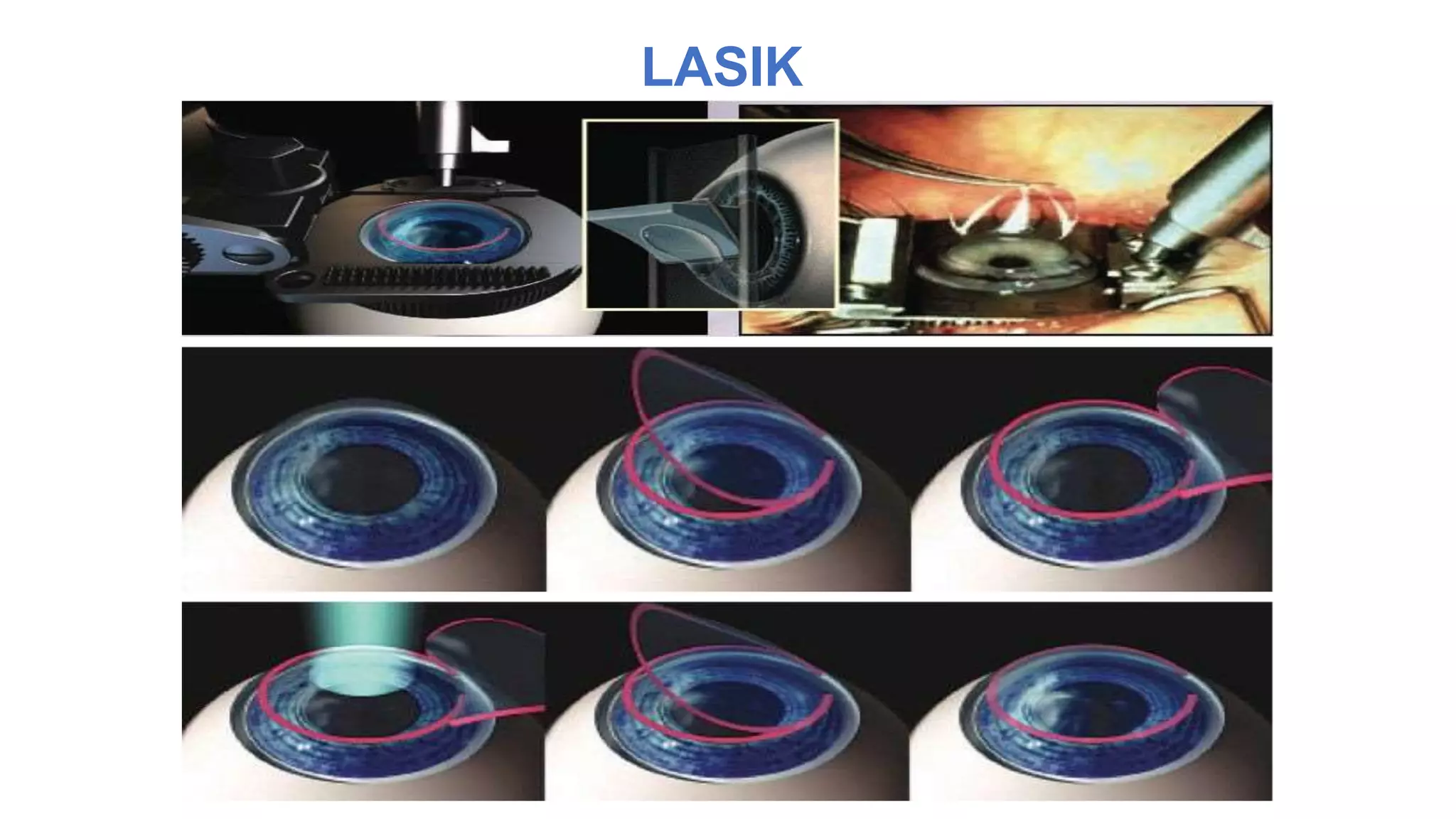 LASIK
 