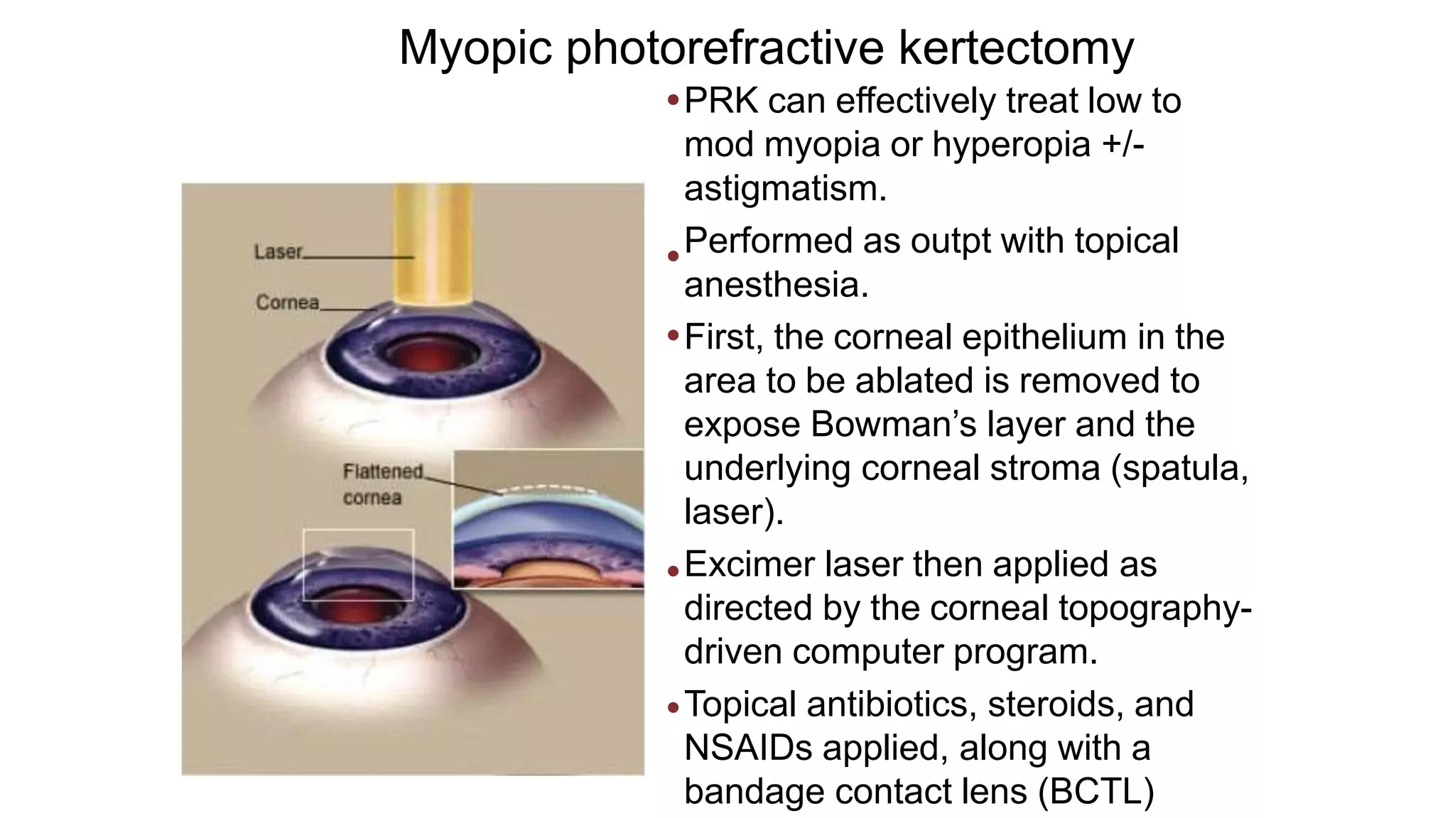 Myopic photorefractive kertectomy
•PRK can effectively treat low to
mod myopia or hyperopia +/-
astigmatism.
Performed as outpt with topical
anesthesia.
First, the corneal epithelium in the
area to be ablated is removed to
expose Bowman’s layer and the
underlying corneal stroma (spatula,
laser).
Excimer laser then applied as
directed by the corneal topography-
driven computer program.
Topical antibiotics, steroids, and
NSAIDs applied, along with a
bandage contact lens (BCTL)
•
•
•
•
 