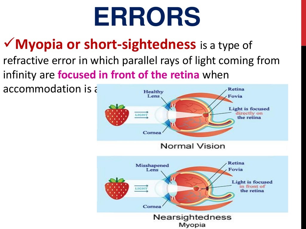Refractive errors