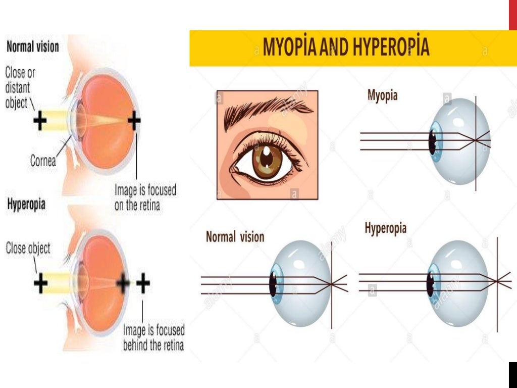 which condition is a common refractive error