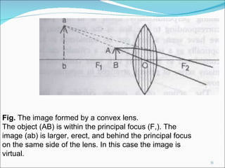 Fig.  The image formed by a convex lens. The object (AB) is within the principal focus (F,). The image (ab) is larger, erect, and behind the principal focus on the same side of the lens. In this case the image is virtual. 
