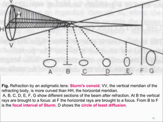 Fig.  Refraction by an astigmatic lens:  Sturm's conoid . VV, the vertical meridian of the refracting body, is more curved than HH, the horizontal meridian. A, B, C, D, E, F, G show different sections of the beam after refraction. At B the vertical rays are brought to a focus: at F the horizontal rays are brought to a focus. From B to F is the  focal interval of Sturm . D shows the  circle of least diffusion . 